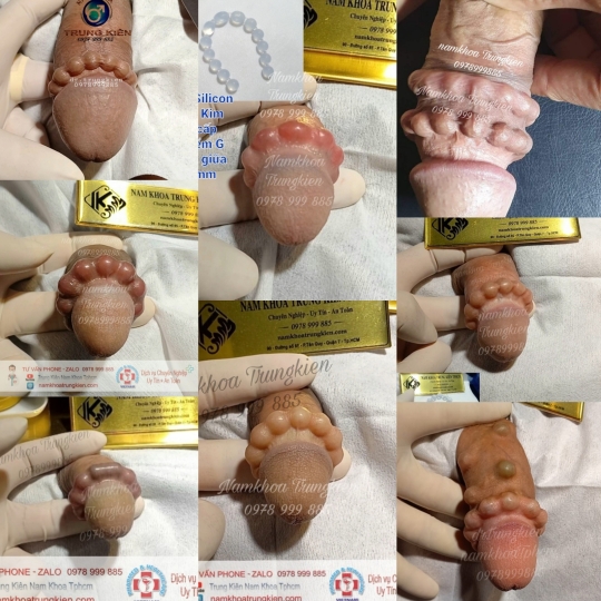 Hình ảnh cắt bao quy đầu cho Nam giới 