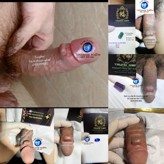 Hình ảnh cắt bao quy đầu cho Nam giới 