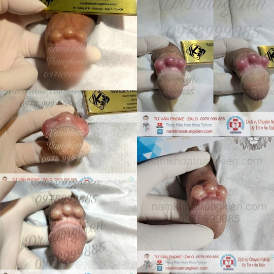 Hình ảnh cắt bao quy đầu cho Nam giới 