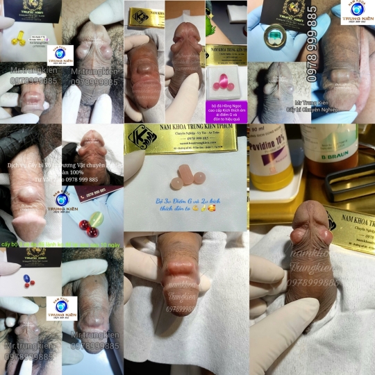 Hình ảnh cắt bao quy đầu cho Nam giới 