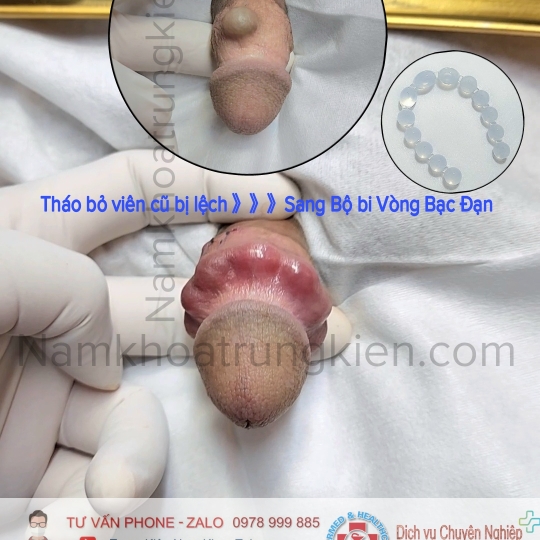 Hình ảnh cắt bao quy đầu cho Nam giới 