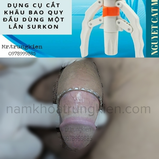 Hình ảnh cắt bao quy đầu cho Nam giới 