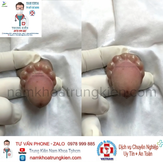 Hình ảnh cắt bao quy đầu cho Nam giới 