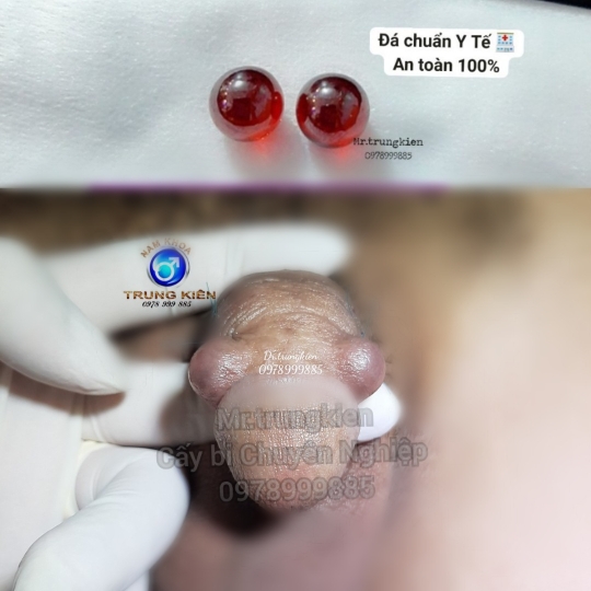 Cấy Bi giúp Đôn To cậu nhỏ hiệu quả - Cấy Bi an toàn Hcm