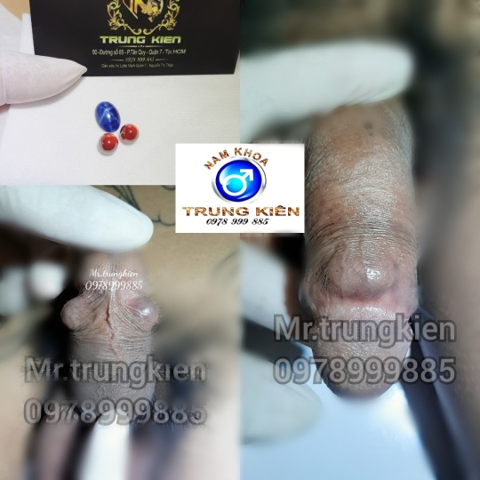 BỘ 3V ĐÔN TO KÍCH CỠ HIỆU QUẢ 