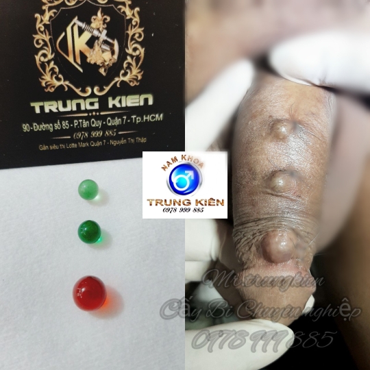 Hình ảnh cắt bao quy đầu an toàn 100% ko Đau