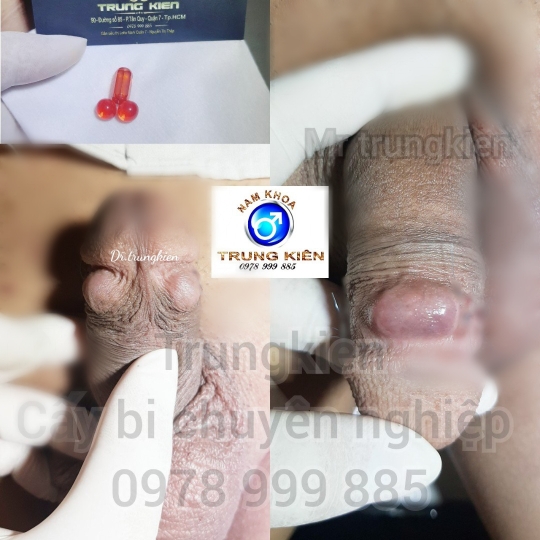 Bộ 3v Bi đá Cao Cấp Đá Ruby