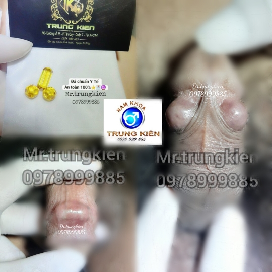 Cấy bi bộ 5 viên Bao Bự Bao Phê cho chị em 