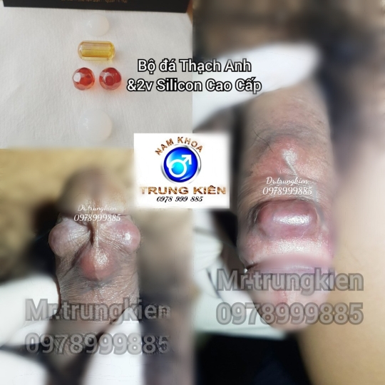 Cấy bi bộ 5 viên Bao Bự Bao Phê cho chị em 