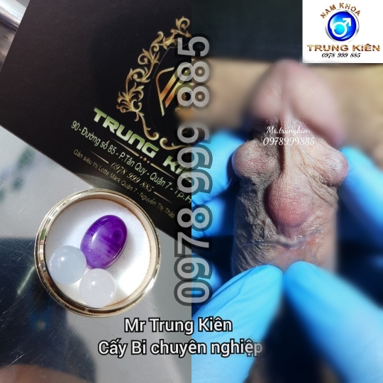 Cấy bi Chuỗi dọc thân Cậu Nhỏ 