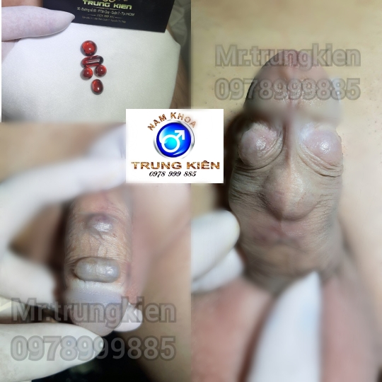 Silicon Nano cao cấp bộ 3v 