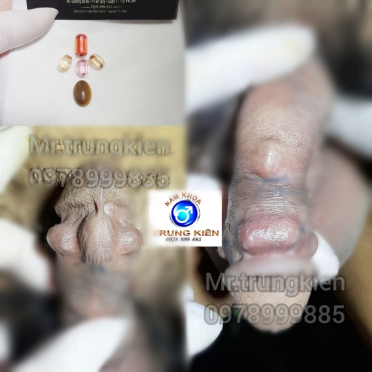 Cấy bi bộ 5 viên Bao Bự Bao Phê cho chị em 