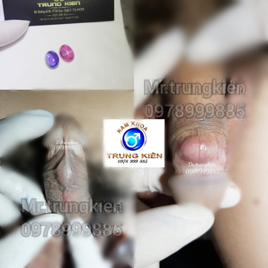 Bộ Bi siêu kích thích đôn to hiệu quả cho Cậu em 