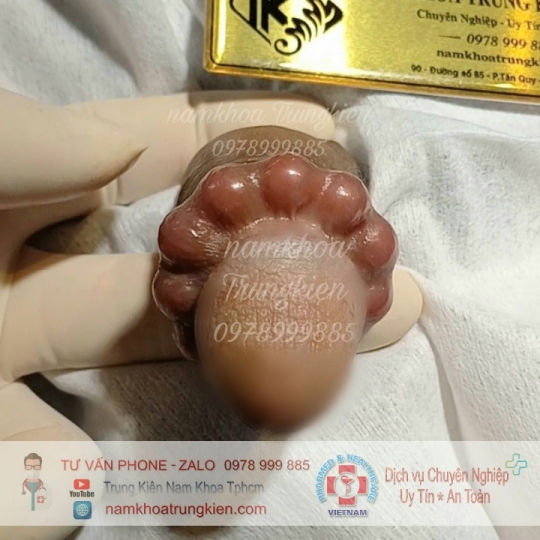 Cấy Bi giúp Đôn To cậu nhỏ hiệu quả - Cấy Bi an toàn Hcm